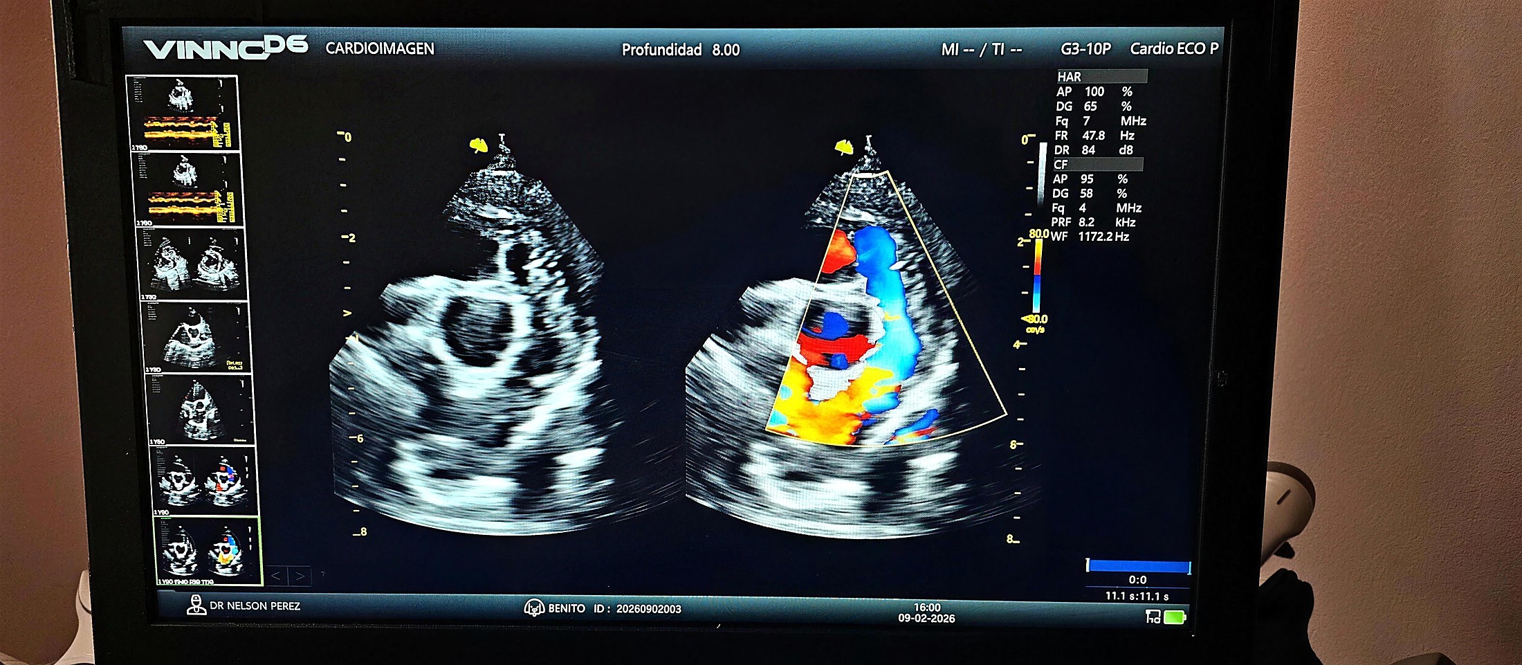 Pantalla del equipo de imágenes de CardioImagen durante un examen